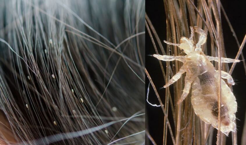 Tất tần tật về con chấy trên đầu người 1