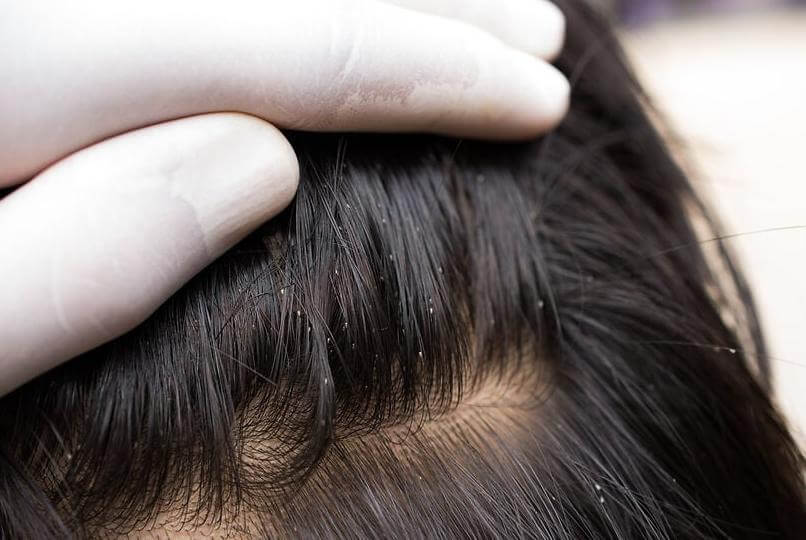 Tất tần tật về con chấy trên đầu người 4